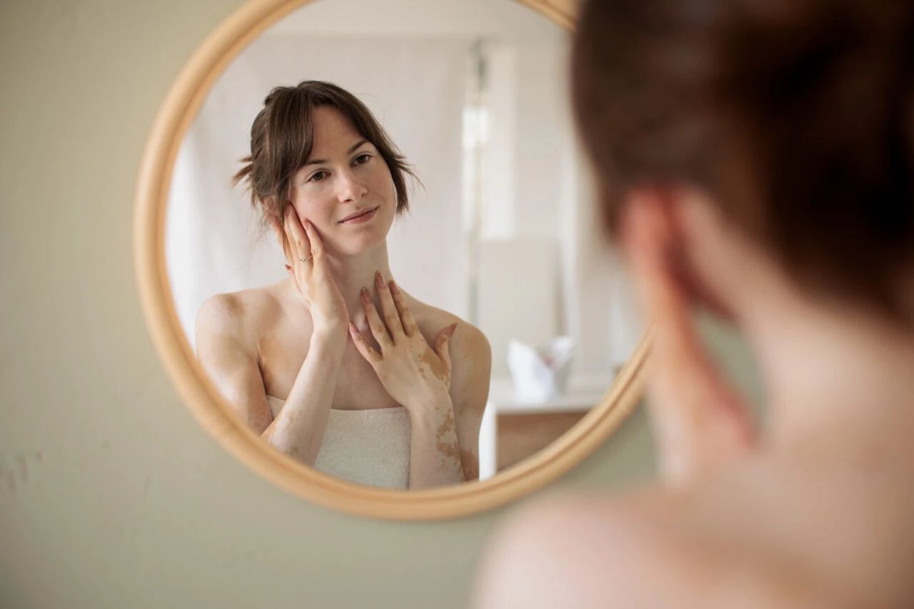una settimana di consulenze dermatologiche gratuite per la vitiligine dal 23 al 28 novembre oltre 30 centri in italia ecco come prenotare