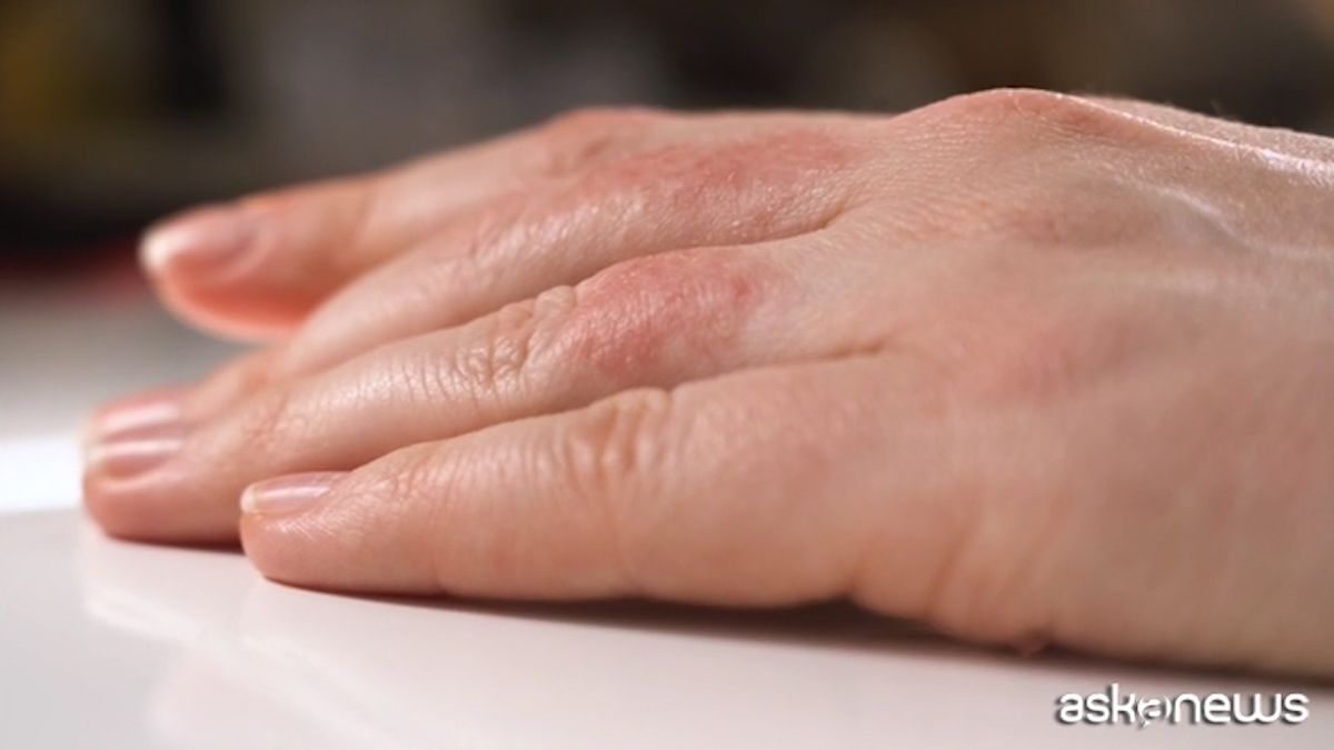 in una fase cruciale per la crescita e le relazioni sociali la patologia infiammatoria cronica della pelle rappresenta una sfida complessa per ragazzi e famiglie oggi arriva una svolta importante